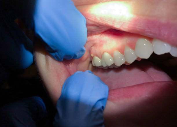 Best Emergency Tooth Extraction in Dove Valley, CO